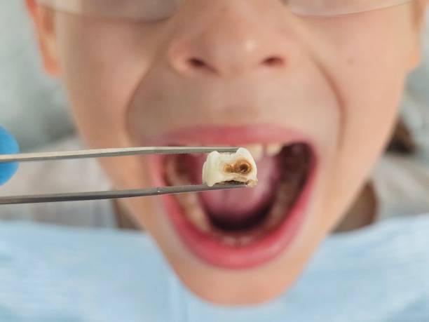 Best Emergency Treatment for Dental Infections or Abscesses in Ramtown, NJ